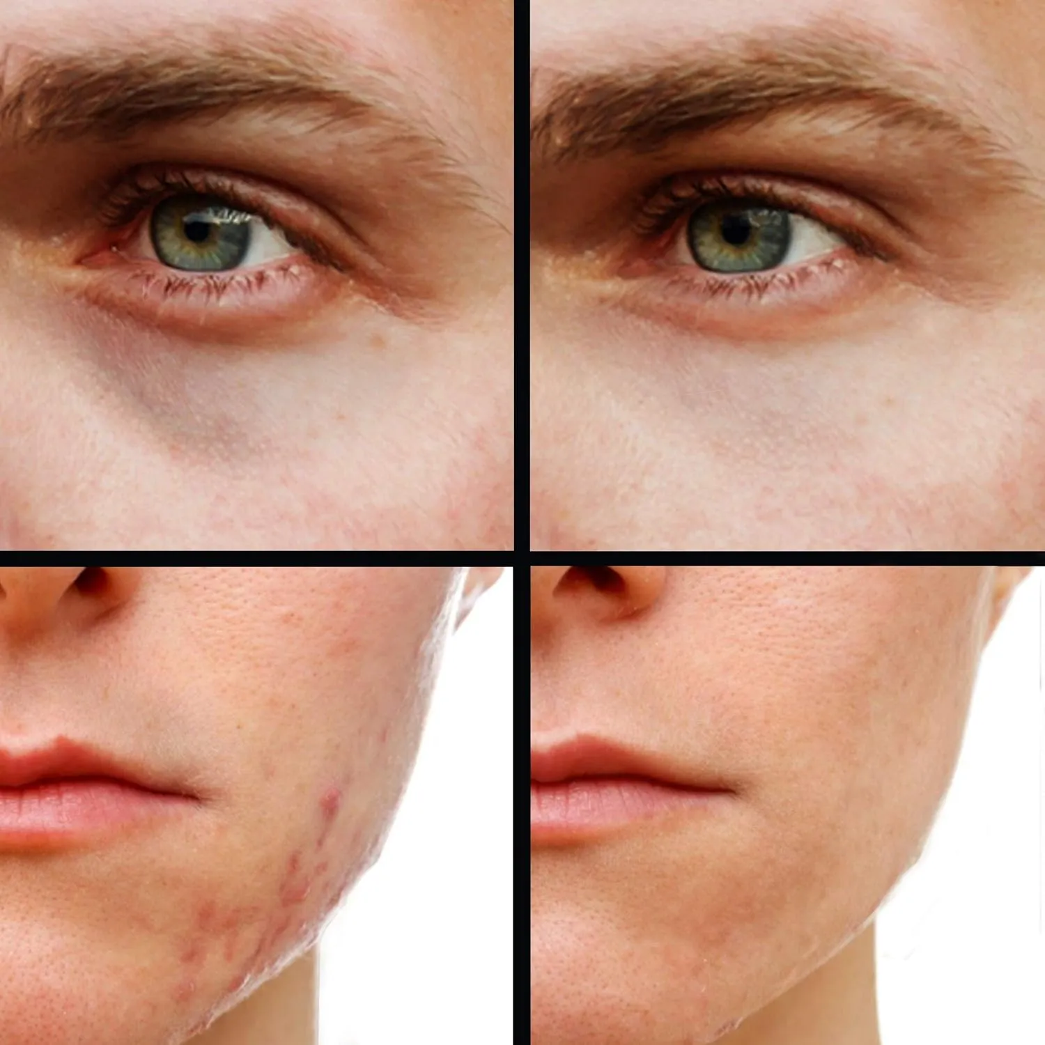 Concealer (Shade 5 of 6) Dark Circle Under Eye Cream Corrector, Multi-Use, Pimples, Scars, Rashes