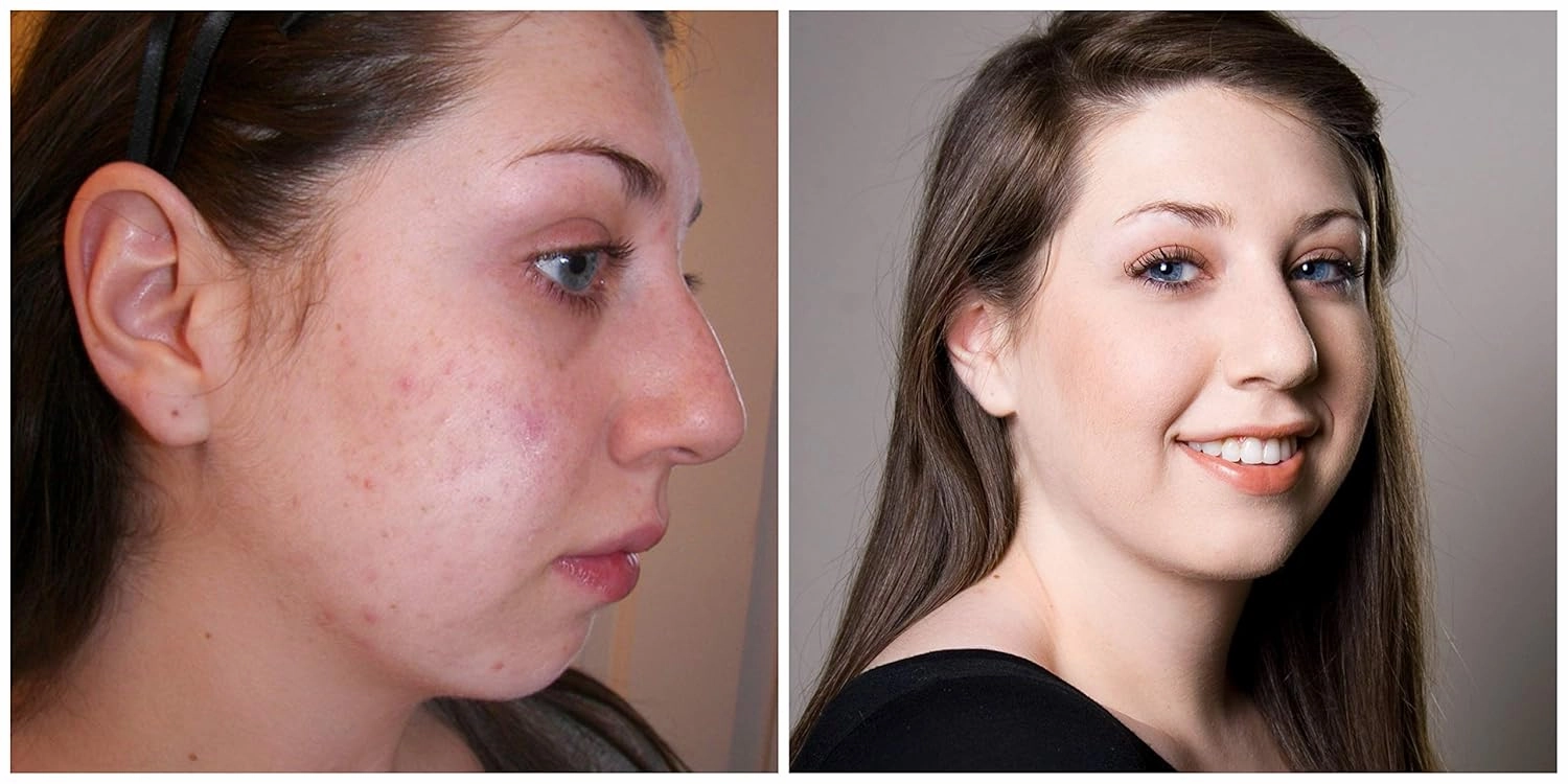Judith August - EraseZit - Acne & Blemish Pencil (Paper Packaging) (Neutral Light)