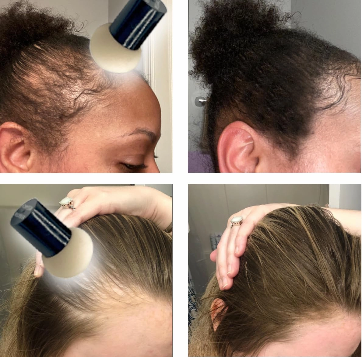 KERATIN RESEARCH Hairline Filler Unisex Mineral Powder Root Touch-Up Hair loss Concealer Scalp & Beard Bald Patch Coverage Fibers for Thinning Hair Waterproof Organic Natural look (WARM MED BROWN, XL)