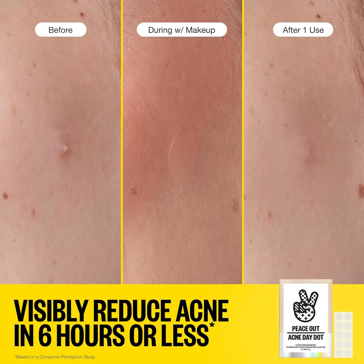 PEACE OUT Acne Day Dot, Sheer Acne Healing Dots, Virtually Invisible Wear, Hydrocolloid Pimple Patches Helps Clear Blemishes Quickly with Encapsulated Salicylic Acid, Retinol & Aloe Vera, 20 dots